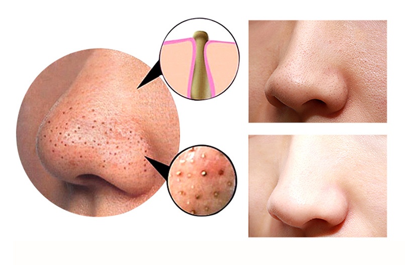 4 in 1 Body Guasha Cupping Blackhead Remover Machine Facial Pore Deep Cleansing Beauty Skin Care - Image 6