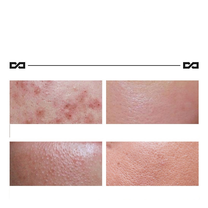 Herbal Lightening Acne Cream Skin Care - Image 6